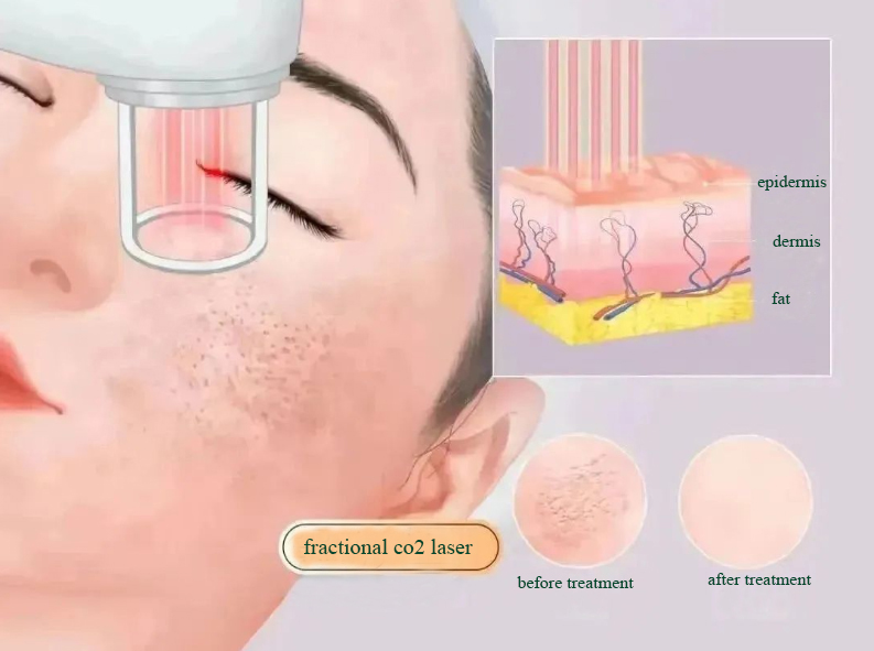 Come prendersi cura della pelle dopo il trattamento di resurfacing con laser Co2?