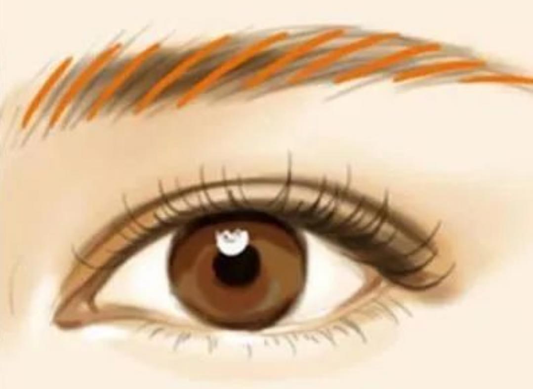 La rimozione del microblading laser (rimozione del tatuaggio del sopracciglio) lascerà cicatrici?