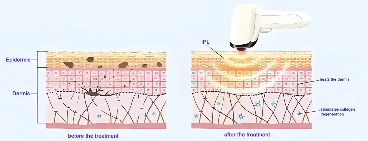 Intense Pulsed Light Skin Rejuvenation