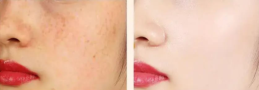 Intense Pulsed Light Photofacial