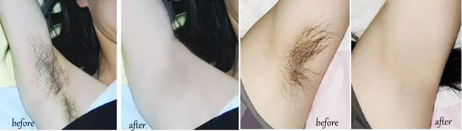 Intense Pulsed Light for Pigmentation