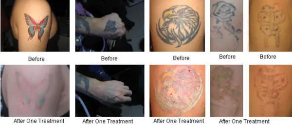 Pulse Light Laser Hair Removal