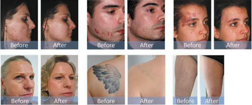IPL Photorejuvenation