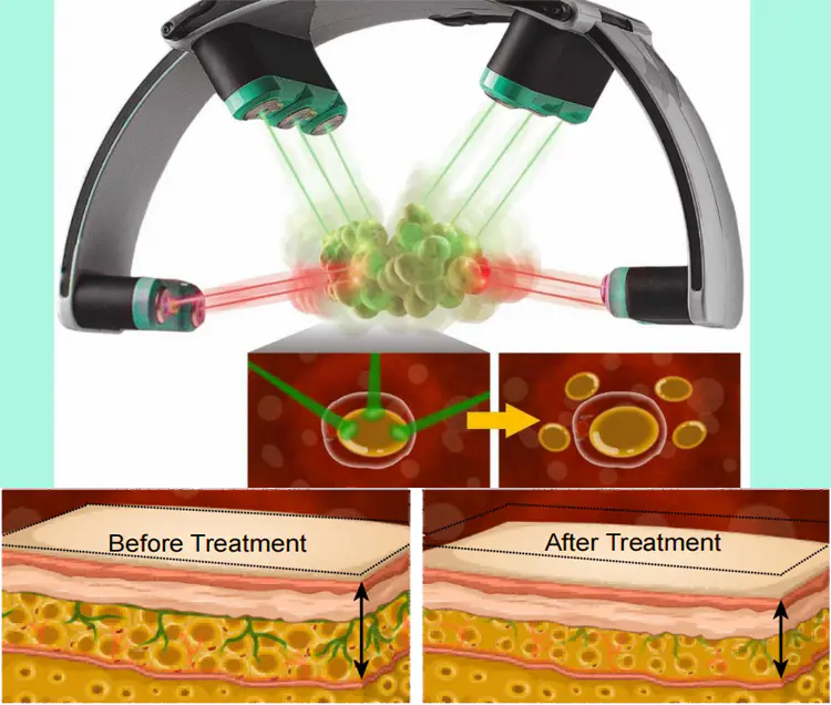 Laser Weight Loss