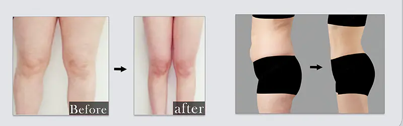 Laser Lipolysis Double Chin