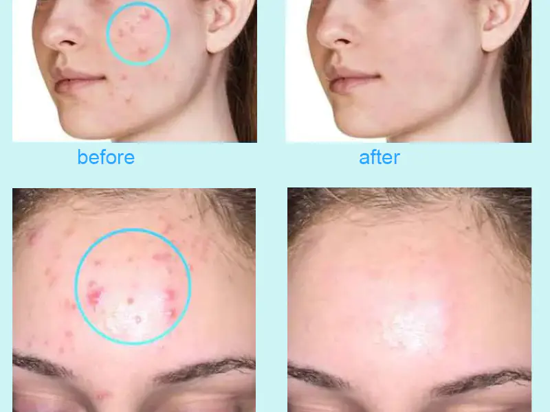 Dermapen Microneedling