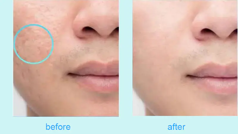 Post Microneedling Care