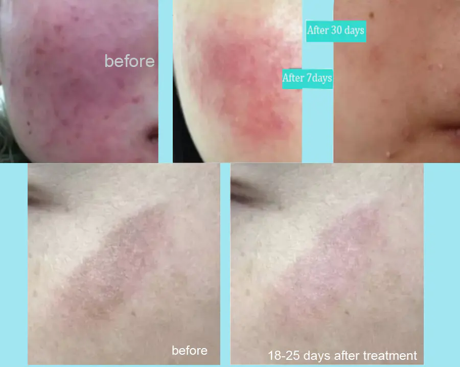 Plasma Eye Lift