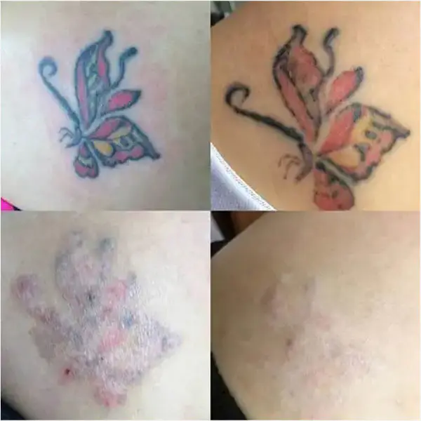 Q Switch Laser Treatment