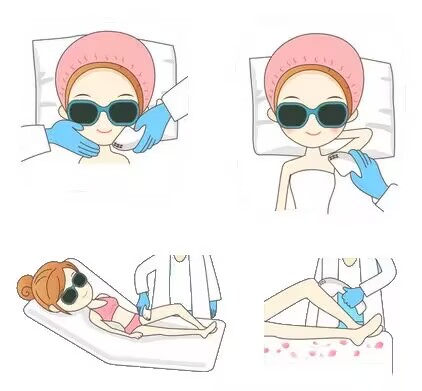 laser hair removal