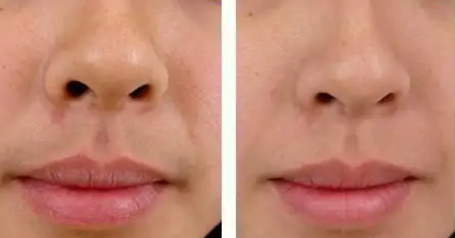 Professional Laser Hair Removal Equipment