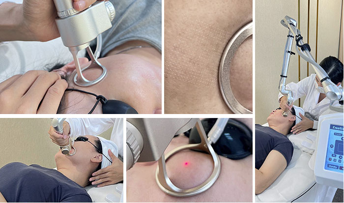 CO2 Fractional Laser