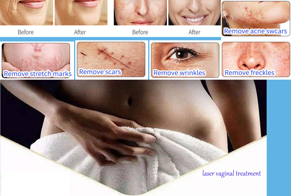 co2 laser hypertrophic scars