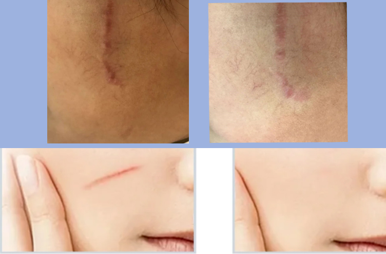 co2 scar