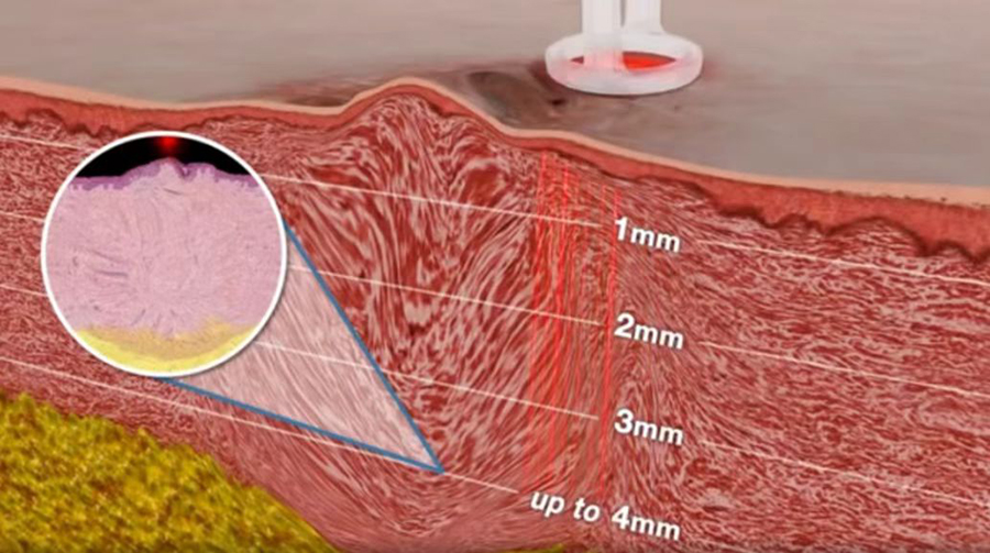 full face co2 laser resurfacing