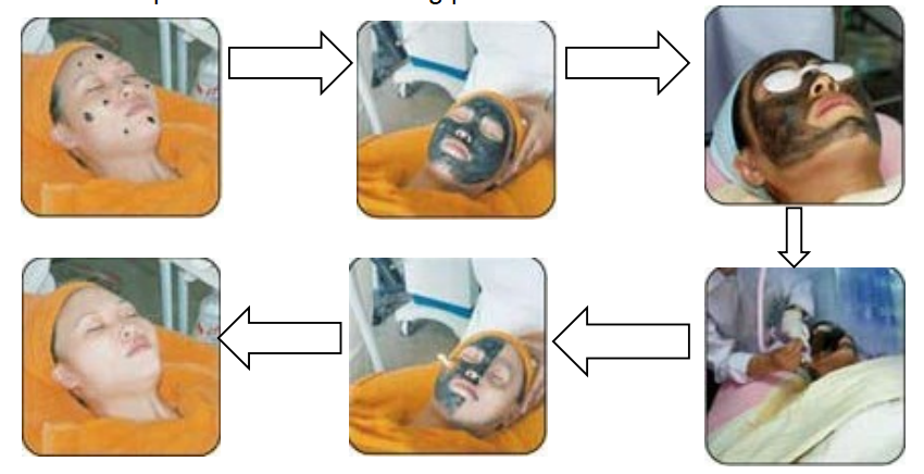 hollywood laser peel