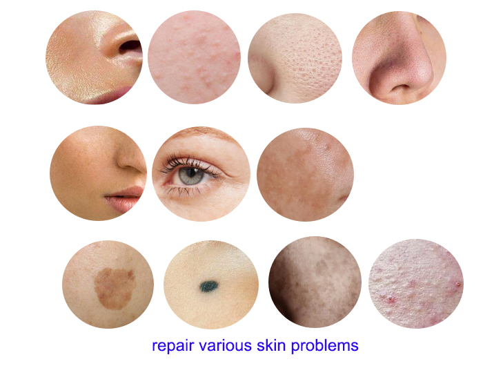 carbon laser benefits
